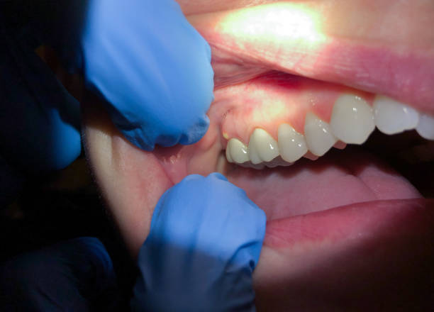 Best Emergency Denture Repair in Fort Shawnee, OH
